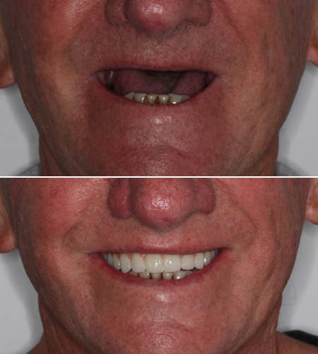 GB Smile Before-After IMG