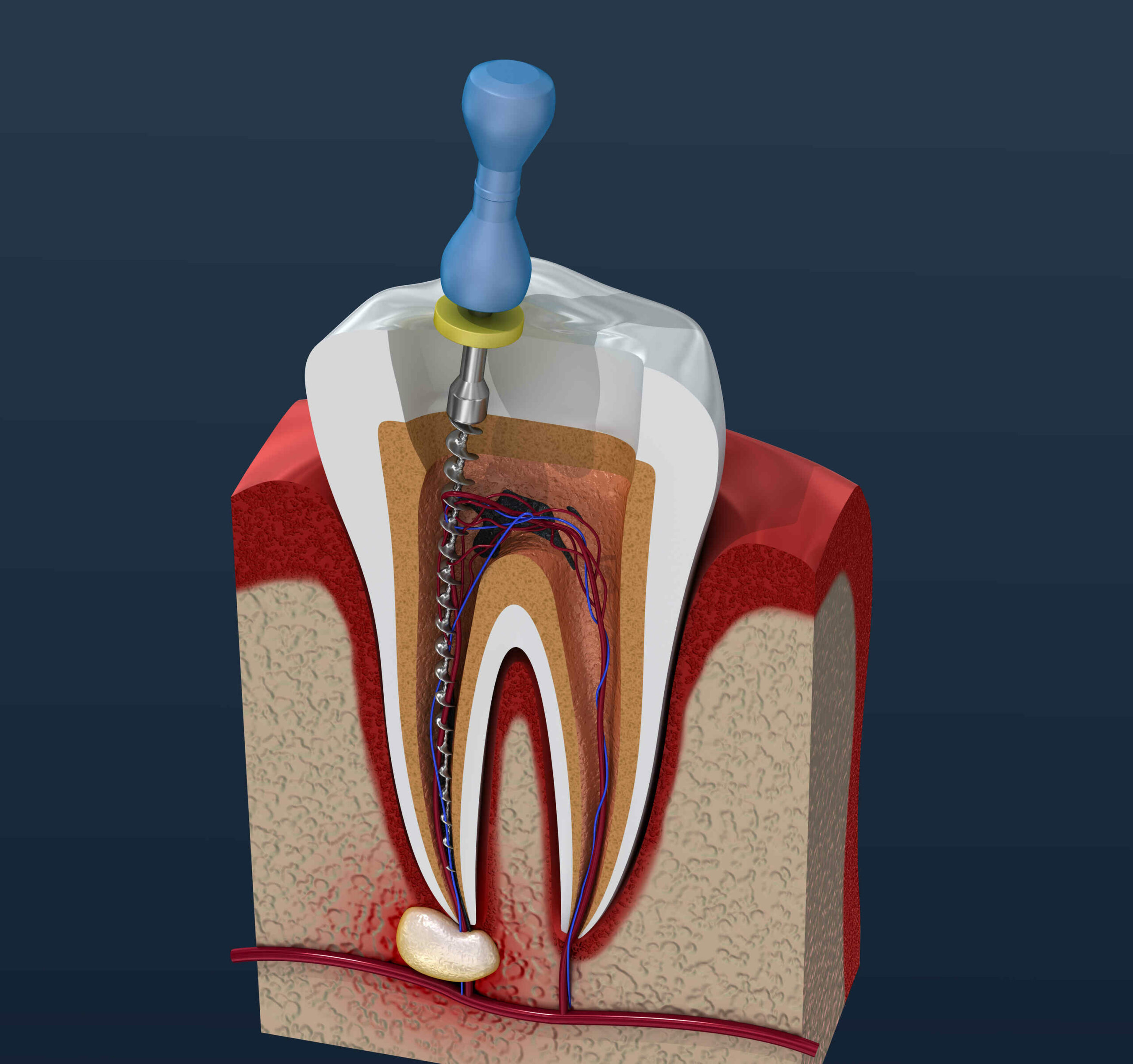 How Much Does the Root Canal Cost in Australia