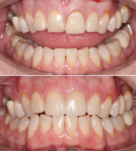 MH Before-After IMG