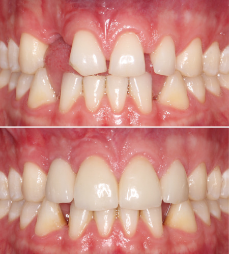 PS - Before - After - front