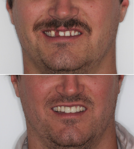 PS Smile Before - After IMG