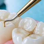 Removing Dental Plaque