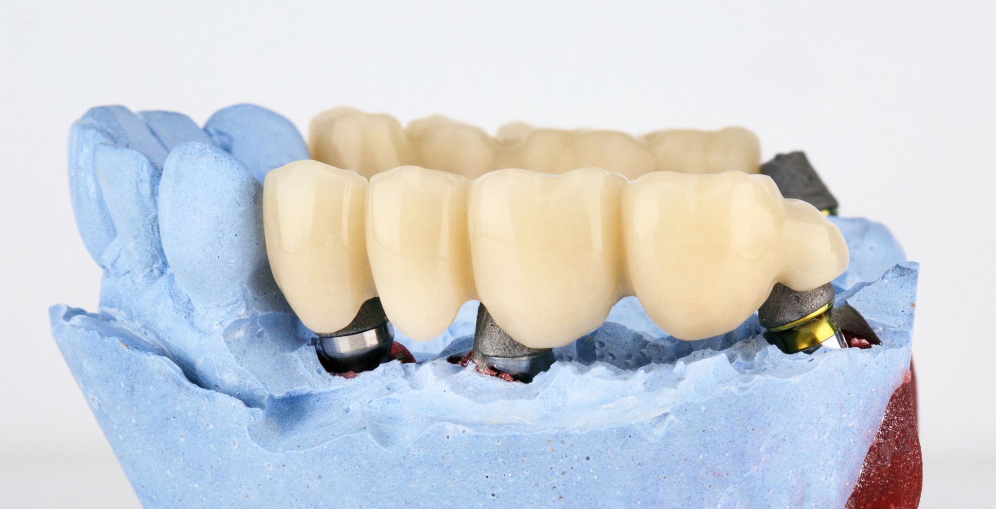 how does a dental bridge work, dental bridge procedure, dental bridge function, replacing missing teeth, types of dental bridges, fixed dental bridge, dental restoration options, how a bridge replaces teeth