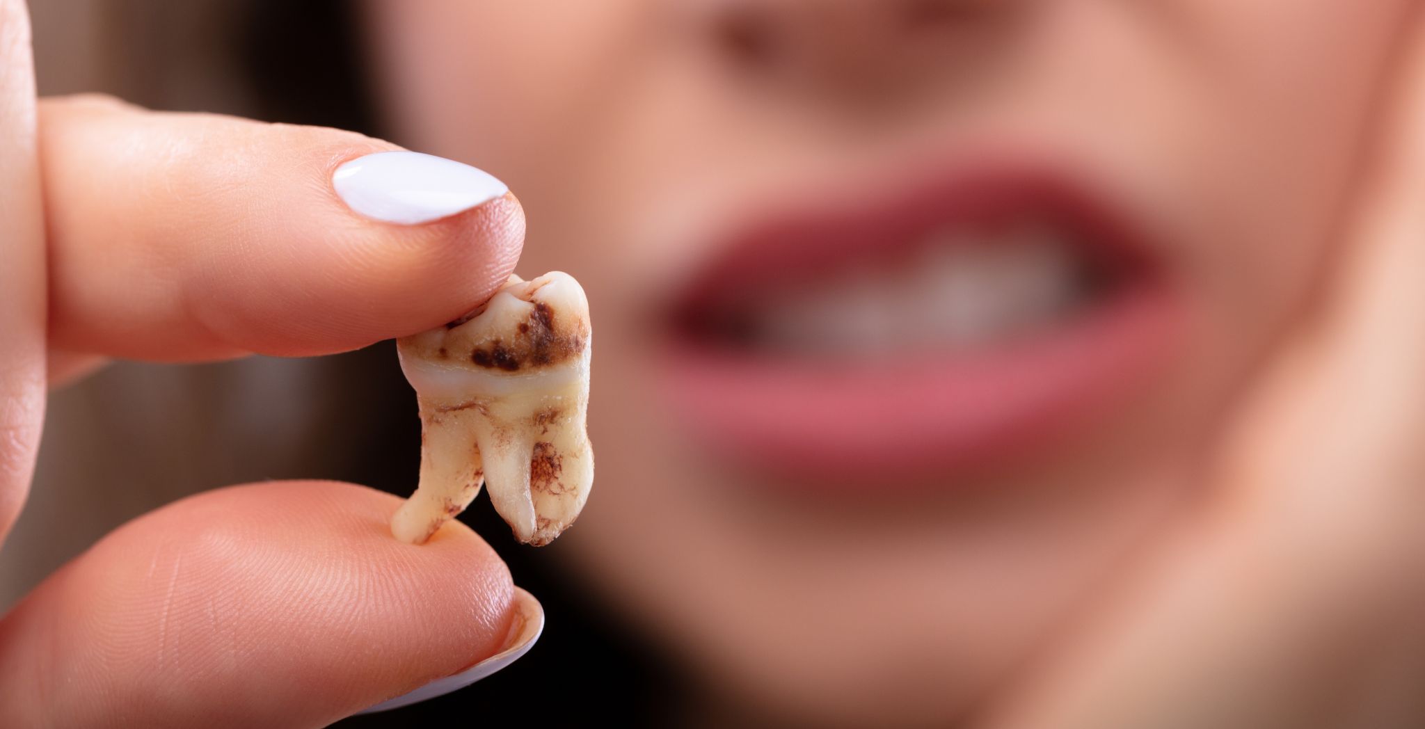 Causes Of Tooth Erosion, Enamel erosion, Acidic foods and tooth erosion, Causes of enamel loss