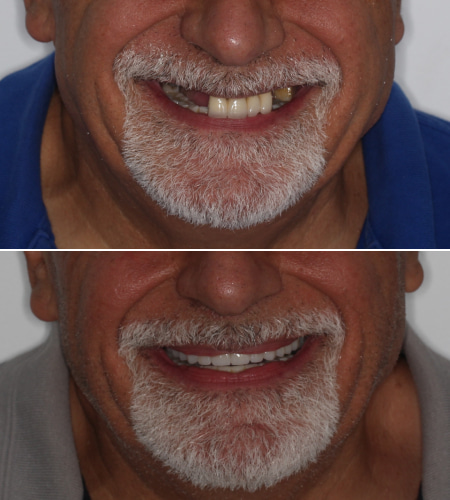 VH Smile Before-After IMG