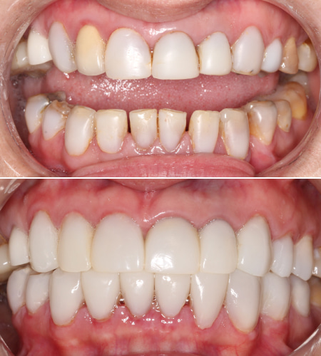 Y Before-After IMG