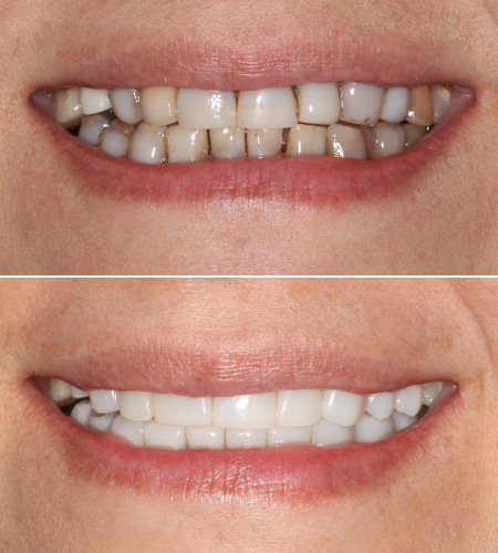 Y Smile Before-After IMG