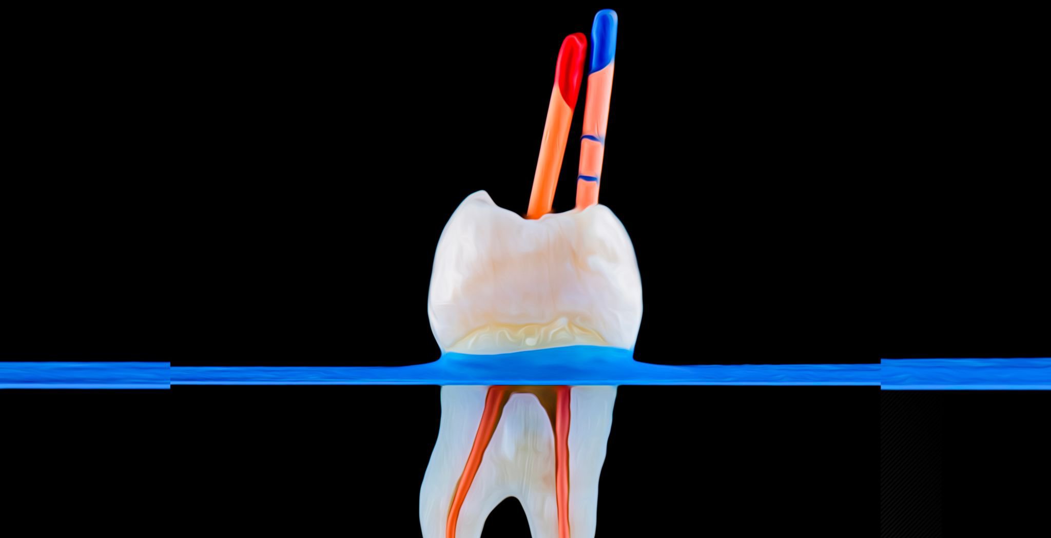 root canal procedure steps, root canal procedure process, root canal procedure at dentist, root canal procedure recovery, root canal procedure pain, root canal procedure treatment,