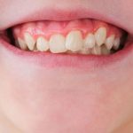 Teeth straightening, Teeth alignment, Orthodontic treatment, Straightening crooked teeth