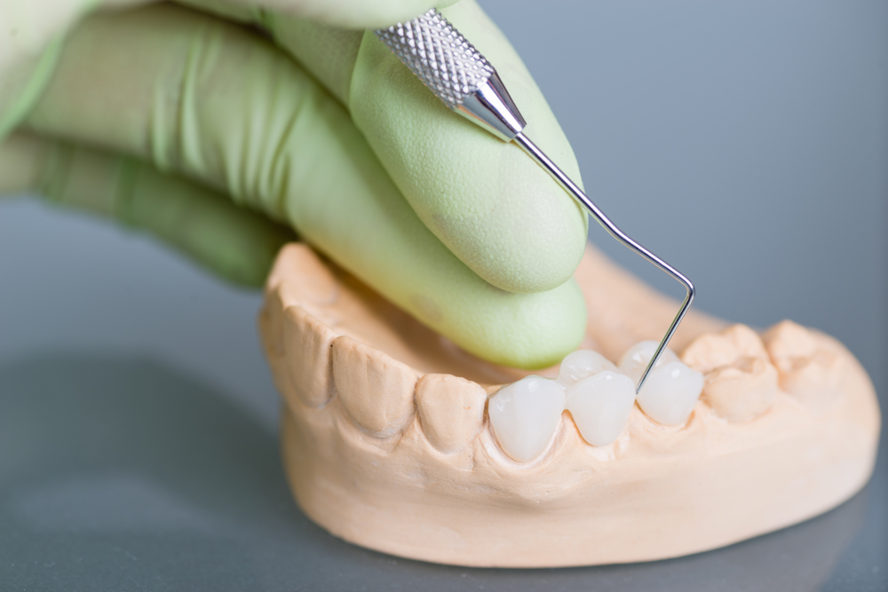 Common Problems of Dental Bridges
