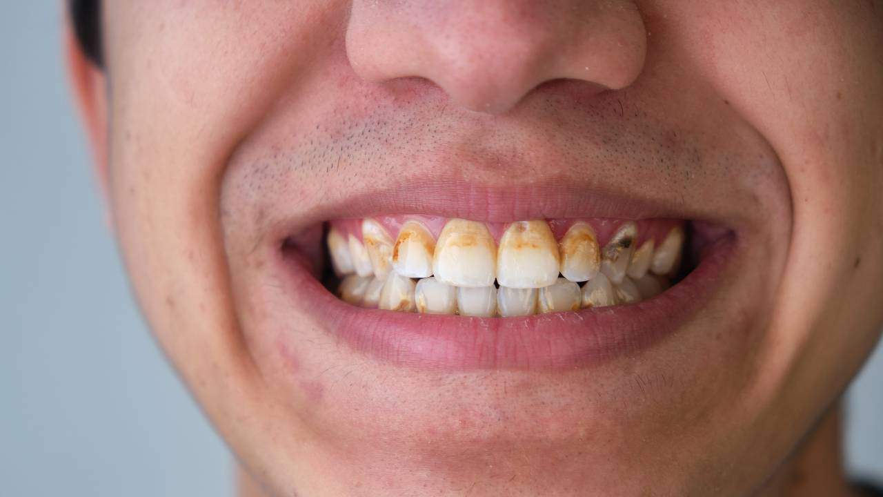 tartar buildup on teeth, Scrape Tartar Off Your Teeth